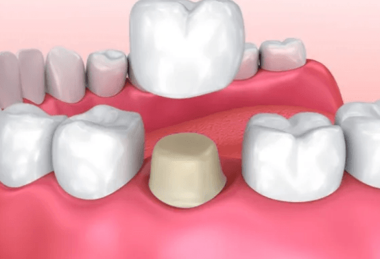 西安牙齿治疗牙齿矫正费用价格表 种牙多少钱一颗？