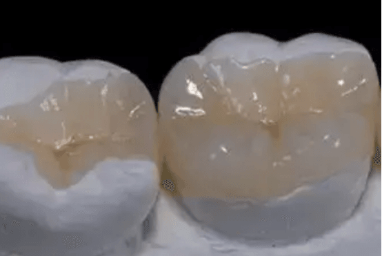 嵌体为什么比牙冠贵 牙冠和嵌体的价格区别大吗
