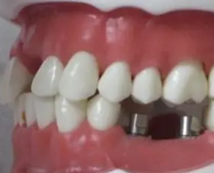 种植牙的牙龈萎缩了怎么办 怎么治疗？