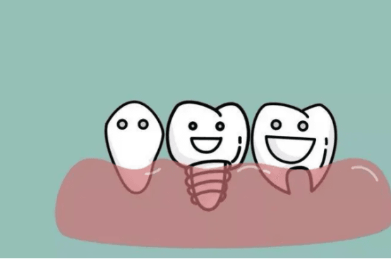 种植牙需要几次才能完成 种牙要做几次手术