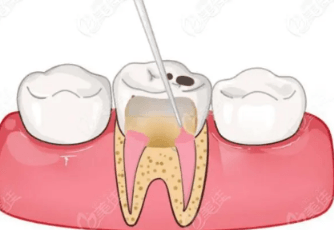 根管治疗后还能种牙吗？并不是所有的根管治疗后都需要种牙
