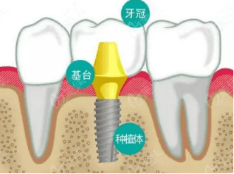 种植牙第三期是干什么 种植牙三期手术是什么