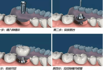 牙齿种植步骤和流程，一般有三个步骤