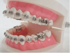 牙齿矫正有必要吗有什么危害？注意影响咬合功能导致其他问题发生