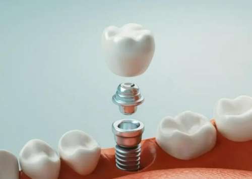 郴州种植牙医院哪家好？本地前十的私立牙科如下，科尔雅口腔是瑞士ITI种植牙国内示范单位！